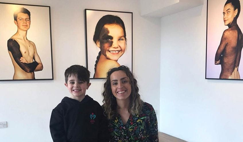 A boy and a woman smiling at the camera, with images in a photography exhibitioin showing people with birthmarks on their bodies behind them