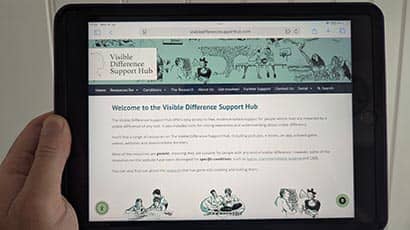 Researchers launch support hub for people with visible differences and their families
